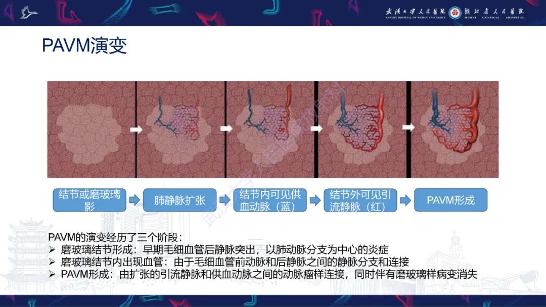 影像PPT - 【PPT】肺动静脉畸形CT诊断-14