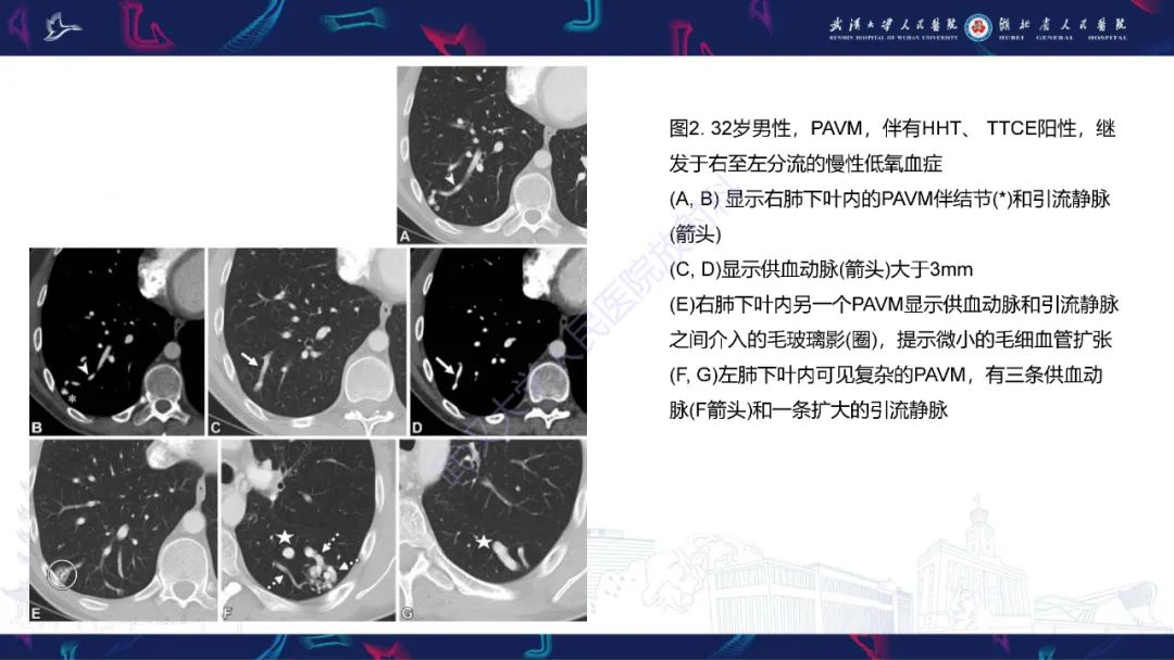 影像PPT - 【PPT】肺动静脉畸形CT诊断-16
