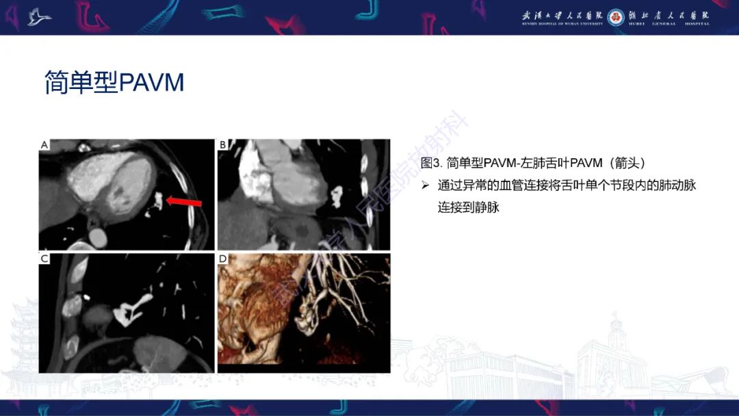 影像PPT - 【PPT】肺动静脉畸形CT诊断-17