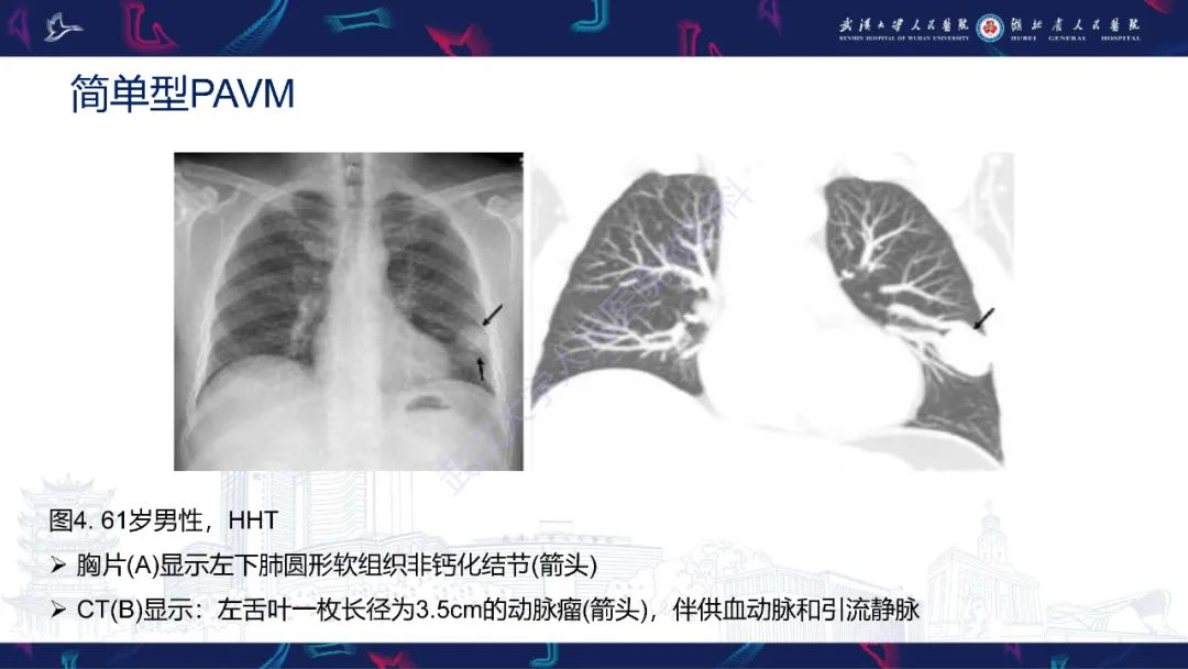 影像PPT - 【PPT】肺动静脉畸形CT诊断-18