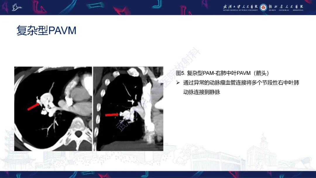 影像PPT - 【PPT】肺动静脉畸形CT诊断-19