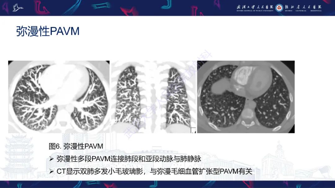 影像PPT - 【PPT】肺动静脉畸形CT诊断-20