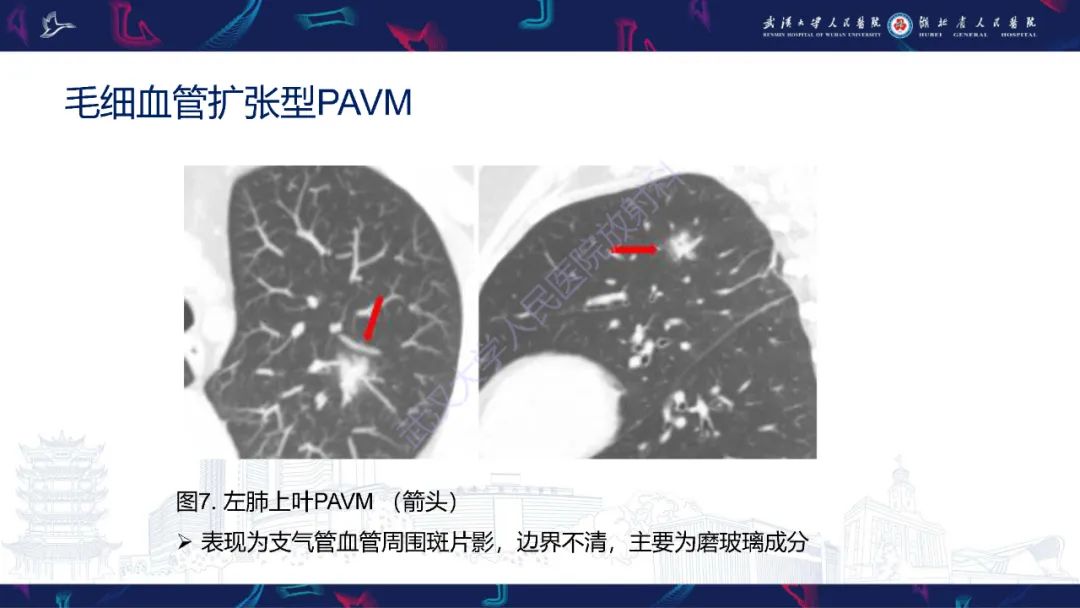 影像PPT - 【PPT】肺动静脉畸形CT诊断-21