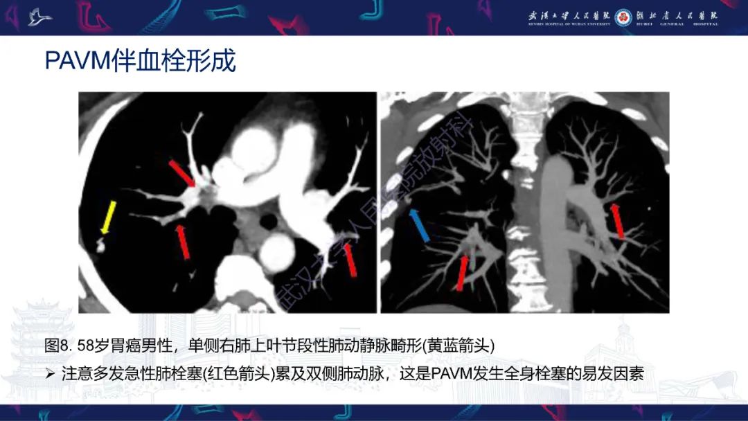 影像PPT - 【PPT】肺动静脉畸形CT诊断-22