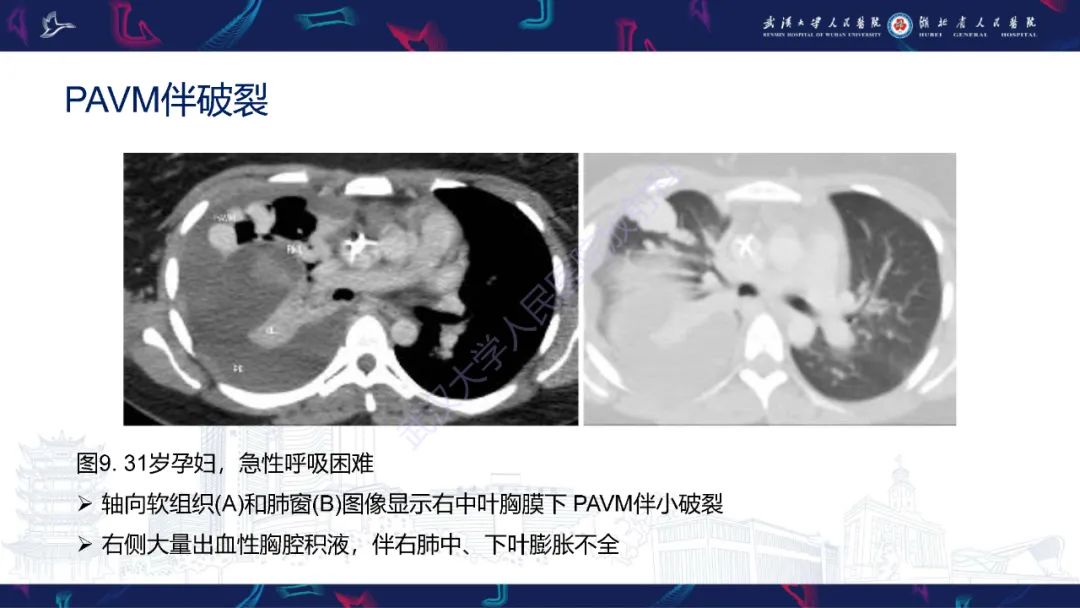 影像PPT - 【PPT】肺动静脉畸形CT诊断-23