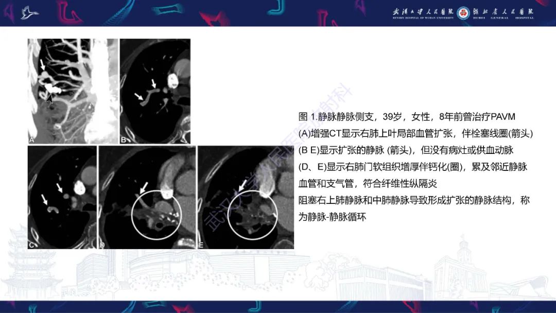 影像PPT - 【PPT】肺动静脉畸形CT诊断-26