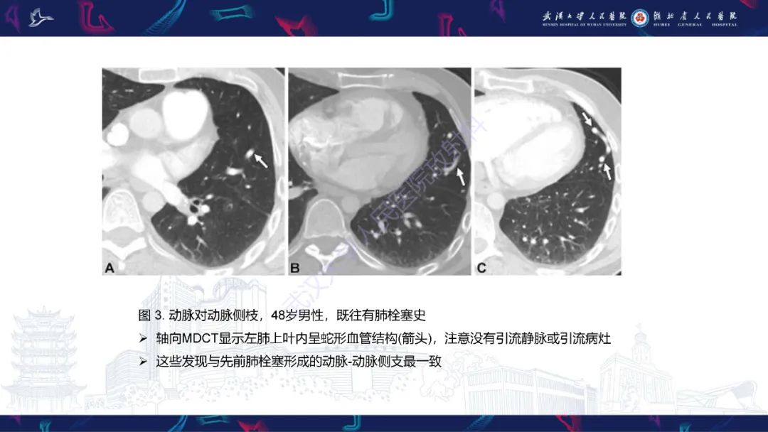 影像PPT - 【PPT】肺动静脉畸形CT诊断-28