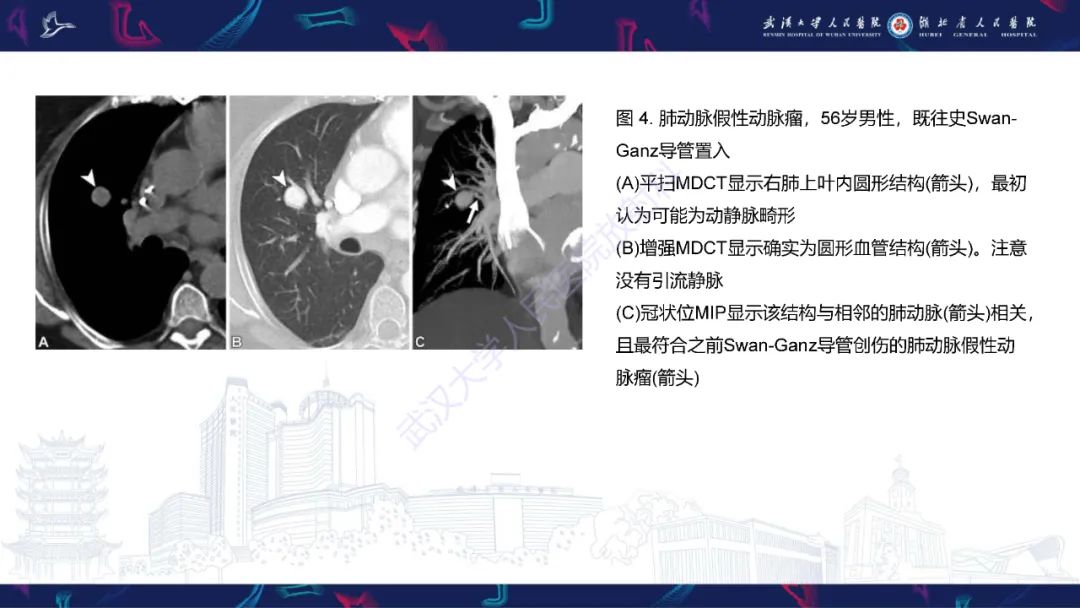 影像PPT - 【PPT】肺动静脉畸形CT诊断-30