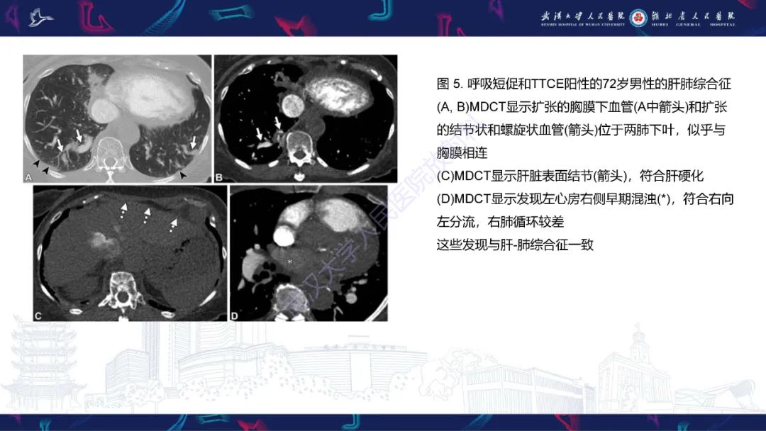 影像PPT - 【PPT】肺动静脉畸形CT诊断-32