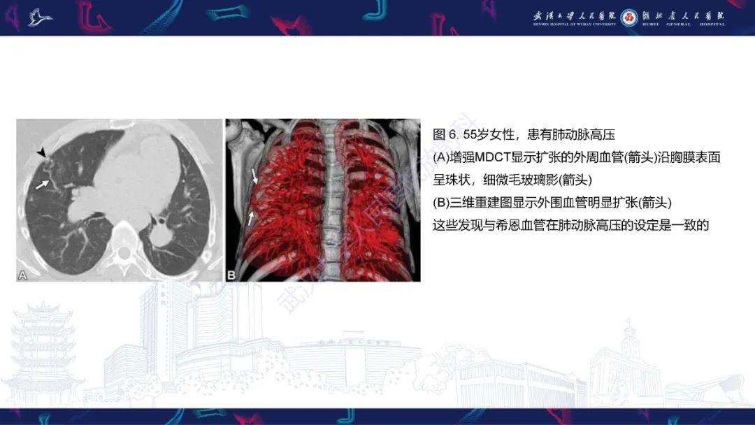 影像PPT - 【PPT】肺动静脉畸形CT诊断-34