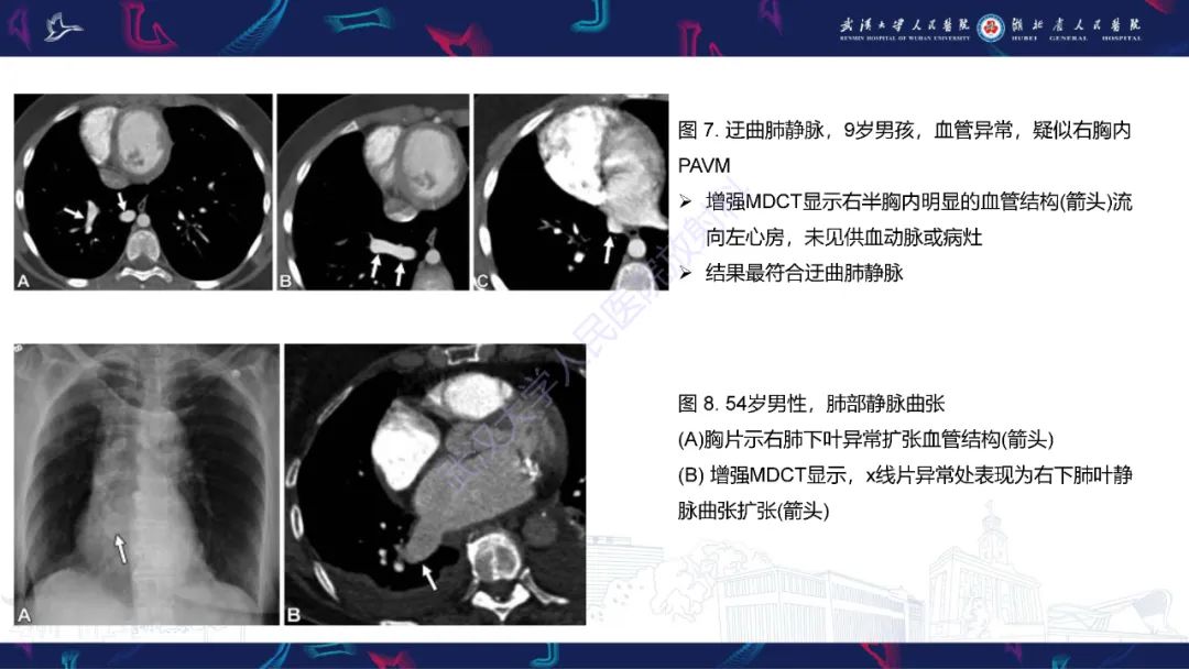 影像PPT - 【PPT】肺动静脉畸形CT诊断-36