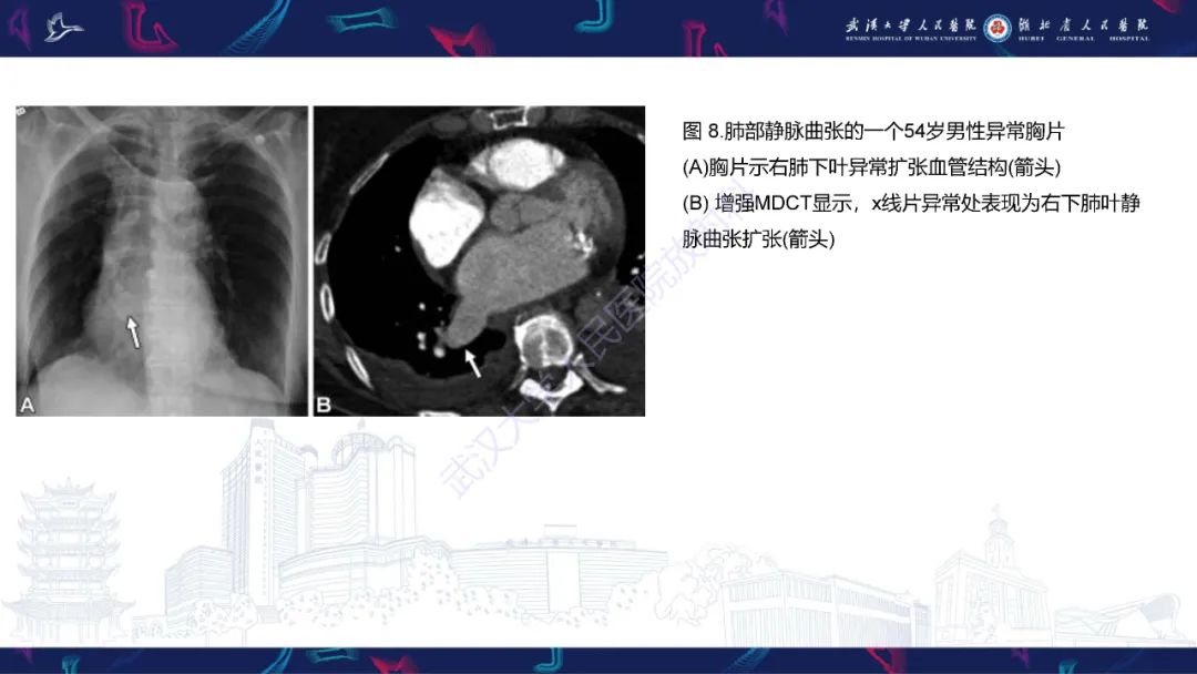 影像PPT - 【PPT】肺动静脉畸形CT诊断-38
