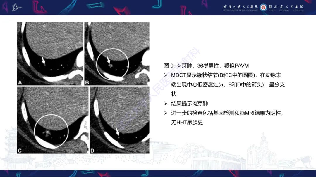 影像PPT - 【PPT】肺动静脉畸形CT诊断-41