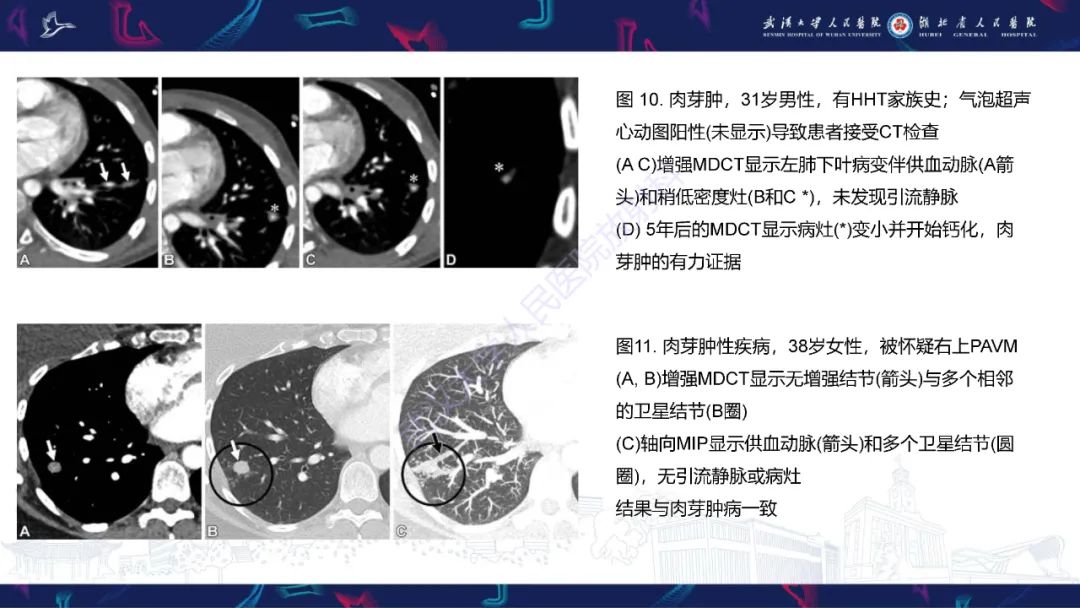 影像PPT - 【PPT】肺动静脉畸形CT诊断-42