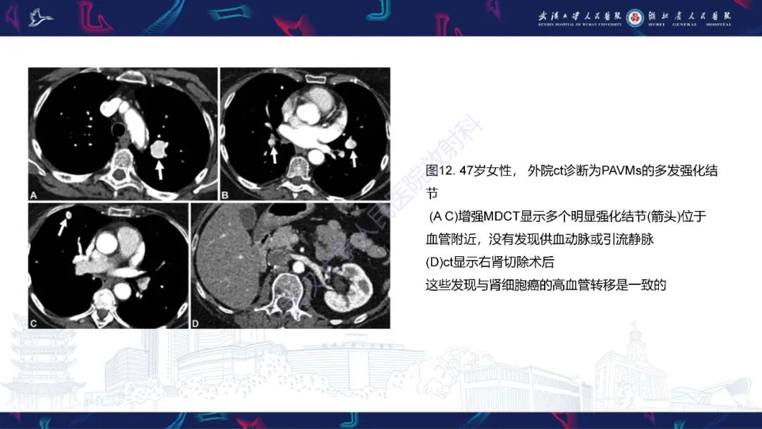 影像PPT - 【PPT】肺动静脉畸形CT诊断-44