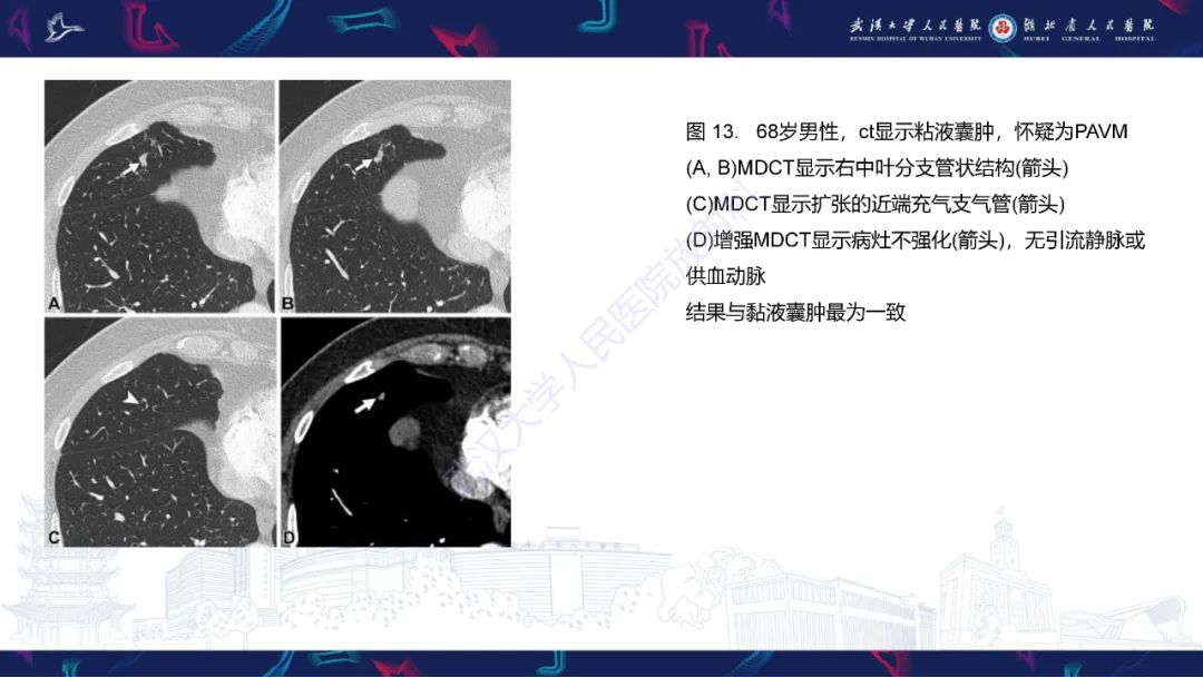 影像PPT - 【PPT】肺动静脉畸形CT诊断-46