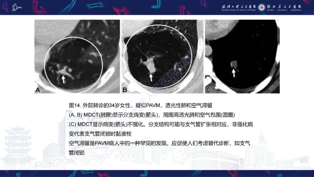 影像PPT - 【PPT】肺动静脉畸形CT诊断-47