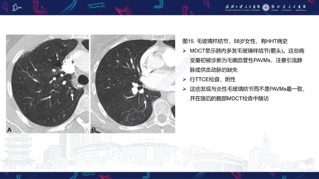 影像PPT - 【PPT】肺动静脉畸形CT诊断-49