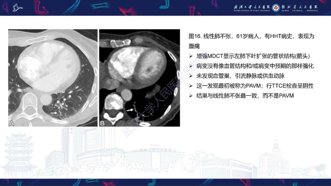 影像PPT - 【PPT】肺动静脉畸形CT诊断-51