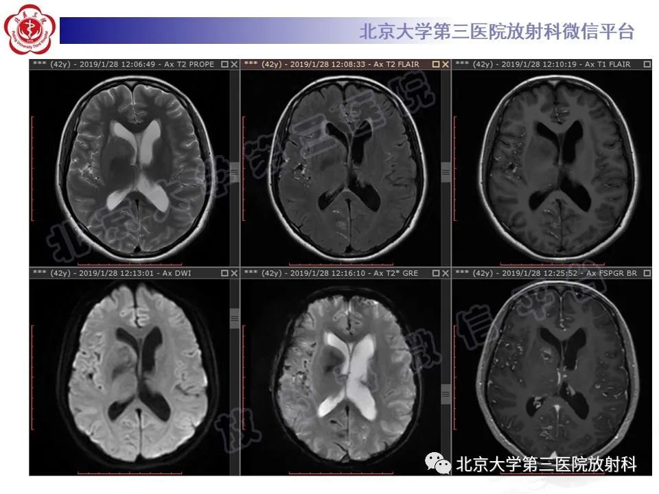 影像PPT - 【PPT】颅内皮样囊肿-3