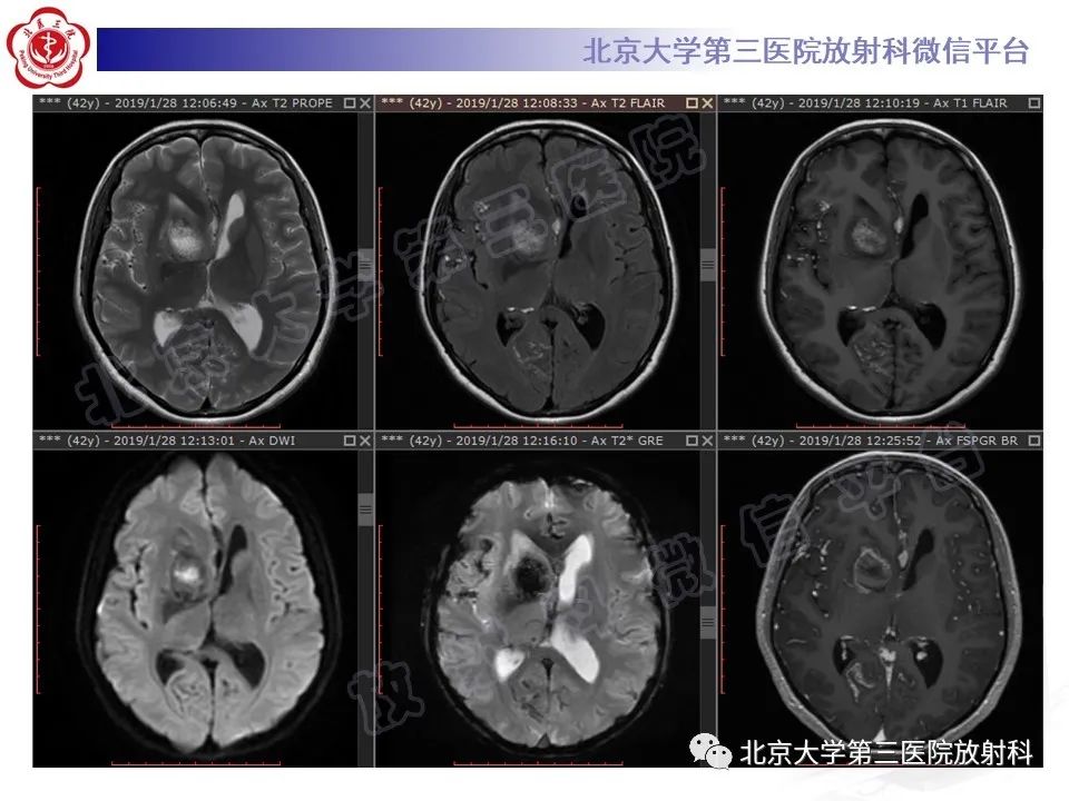 影像PPT - 【PPT】颅内皮样囊肿-4