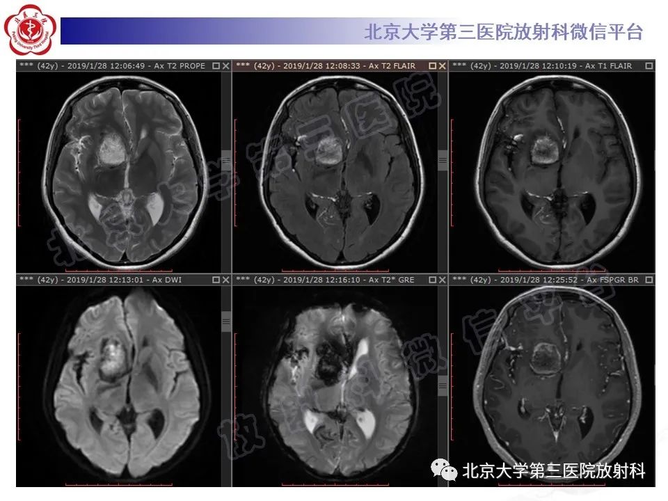 影像PPT - 【PPT】颅内皮样囊肿-5