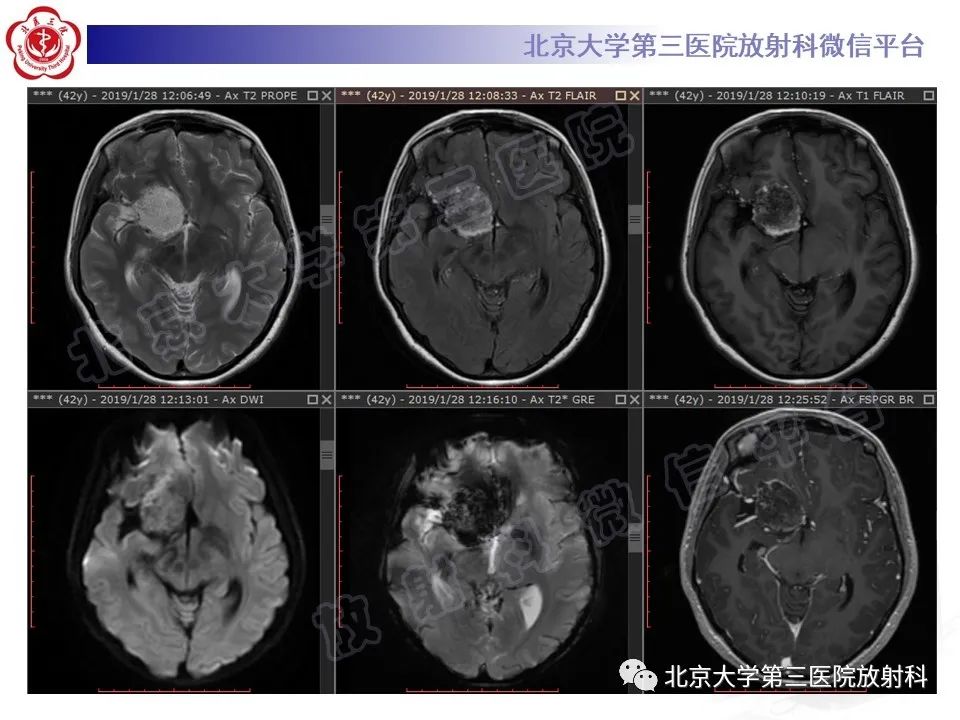 影像PPT - 【PPT】颅内皮样囊肿-6