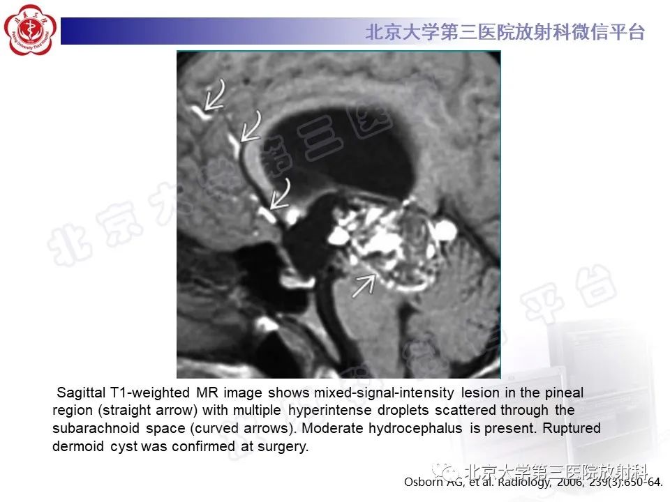 影像PPT - 【PPT】颅内皮样囊肿-25