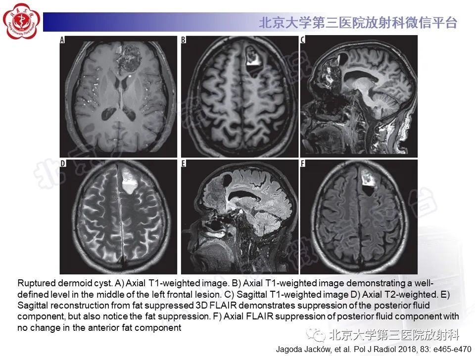 影像PPT - 【PPT】颅内皮样囊肿-26