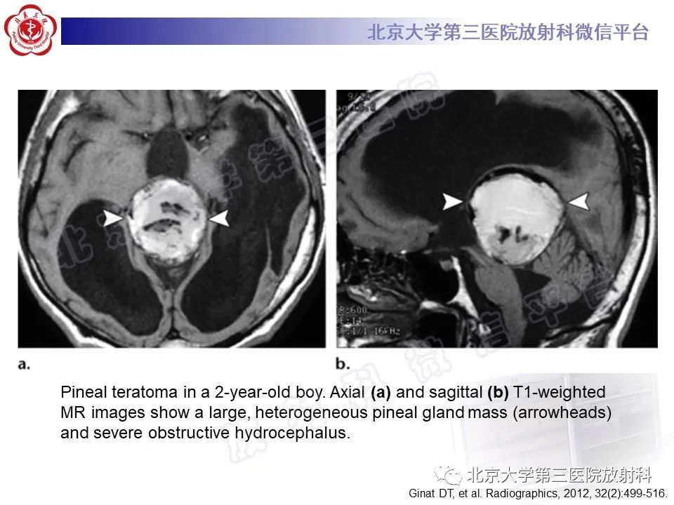 影像PPT - 【PPT】颅内皮样囊肿-30