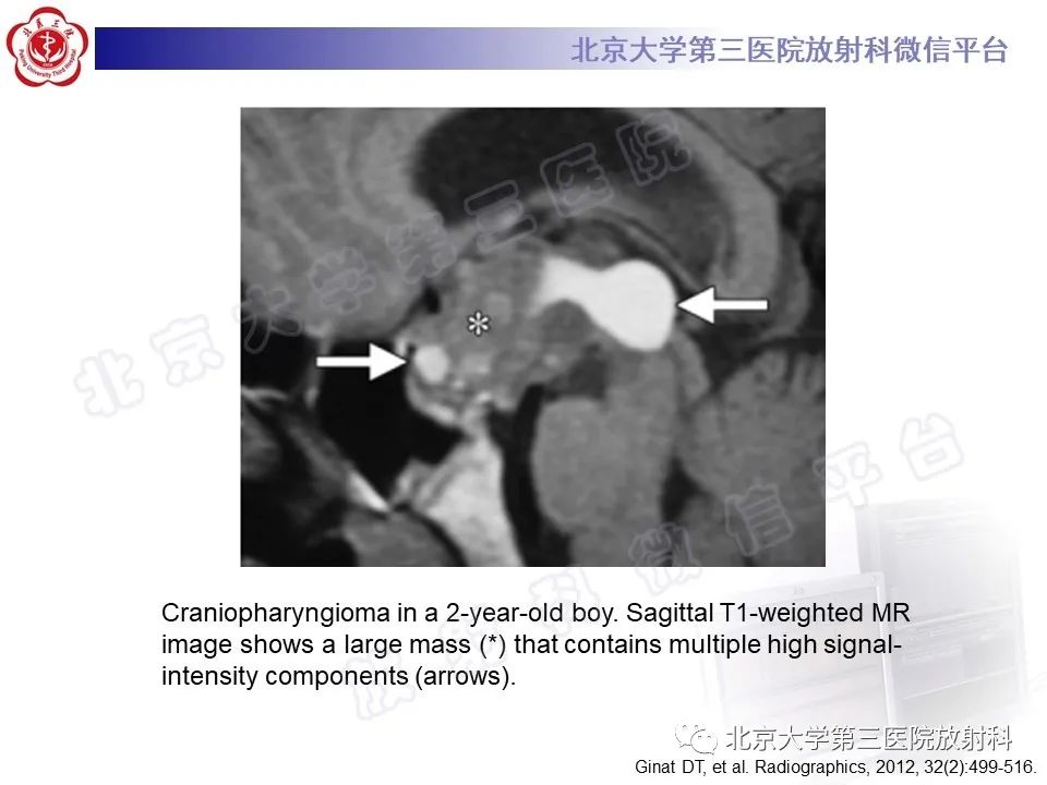 影像PPT - 【PPT】颅内皮样囊肿-32