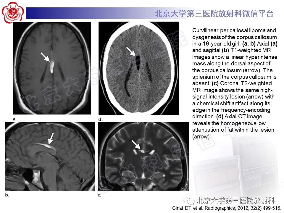 影像PPT - 【PPT】颅内皮样囊肿-34