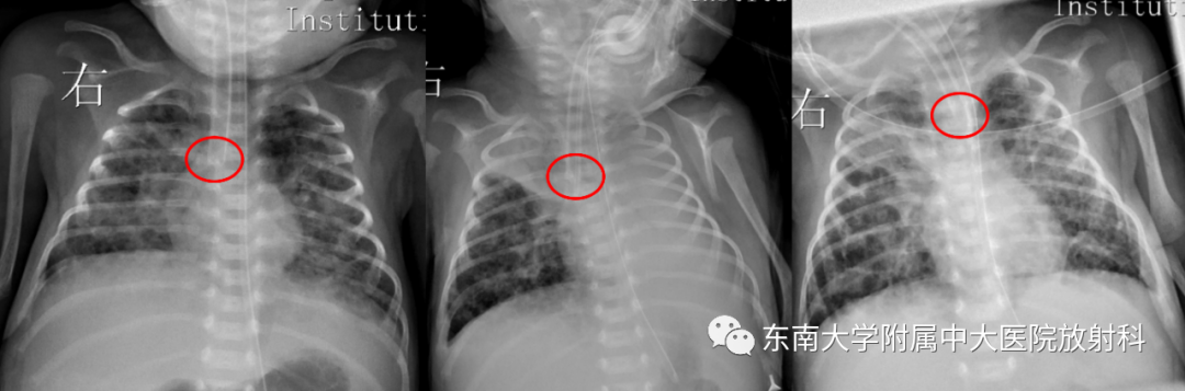 影像PPT - 【PPT】体内常见置管位置影像评估-3