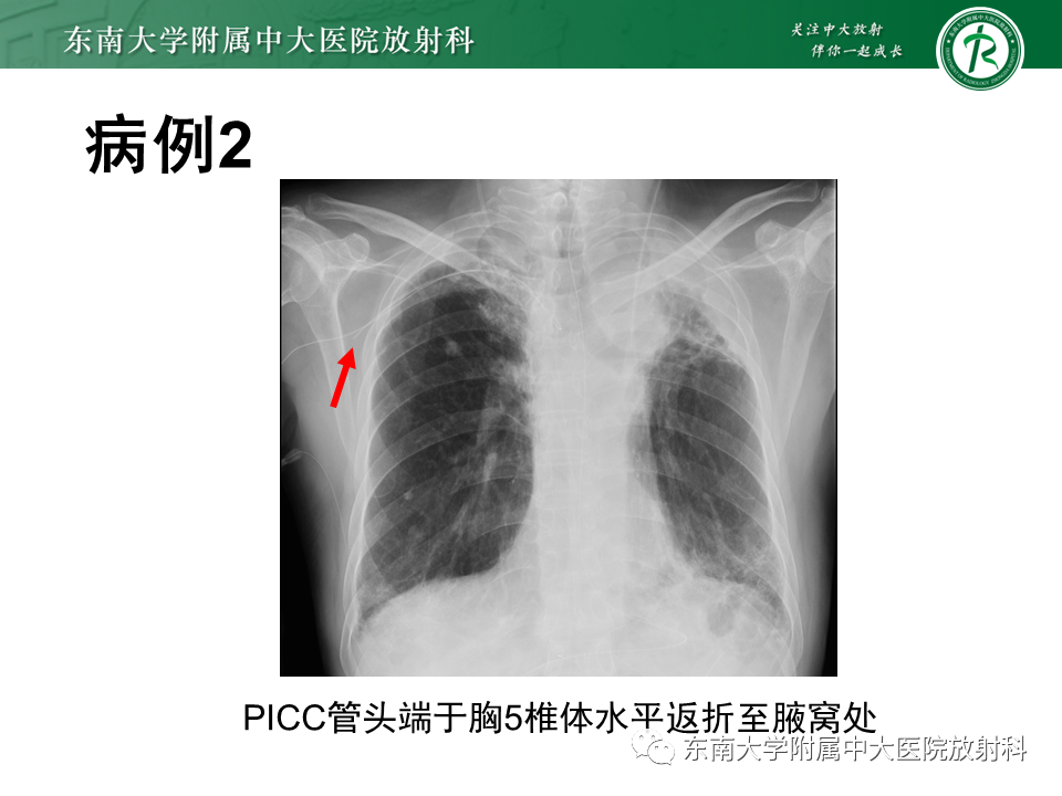 影像PPT - 【PPT】体内常见置管位置影像评估-5
