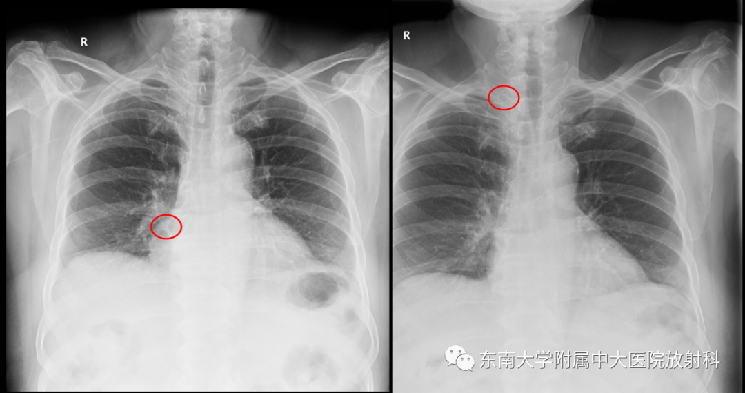 影像PPT - 【PPT】体内常见置管位置影像评估-1