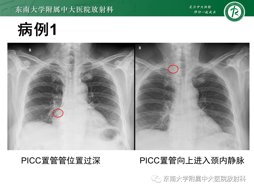 影像PPT - 【PPT】体内常见置管位置影像评估-4
