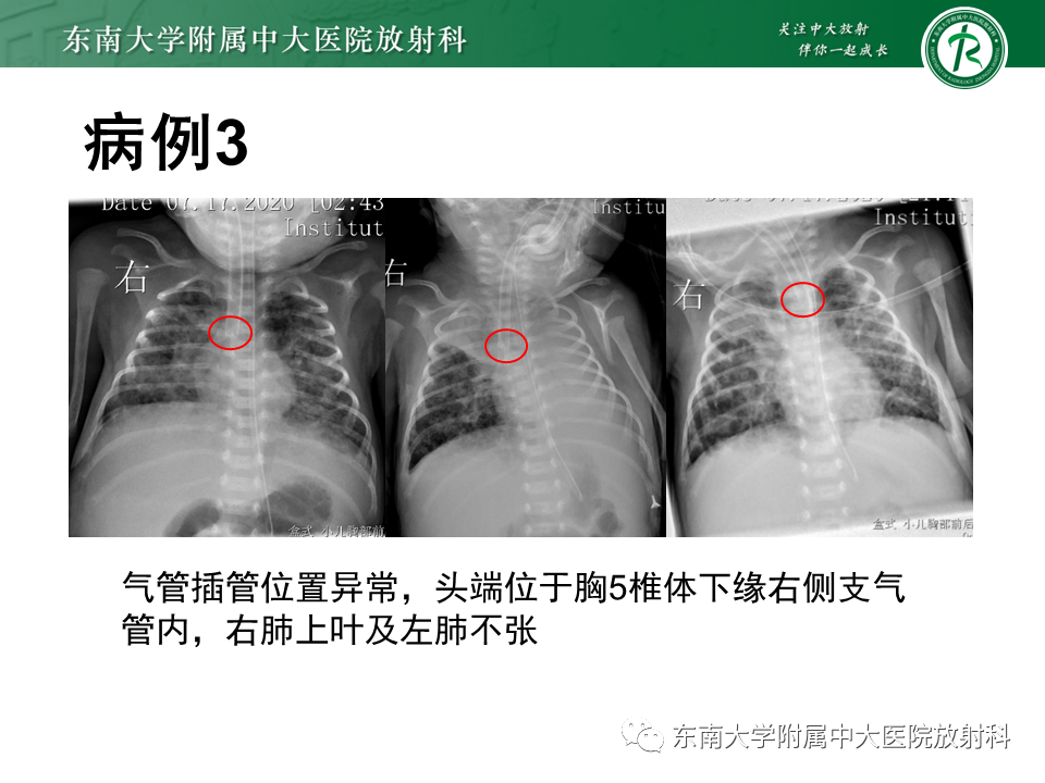 影像PPT - 【PPT】体内常见置管位置影像评估-6