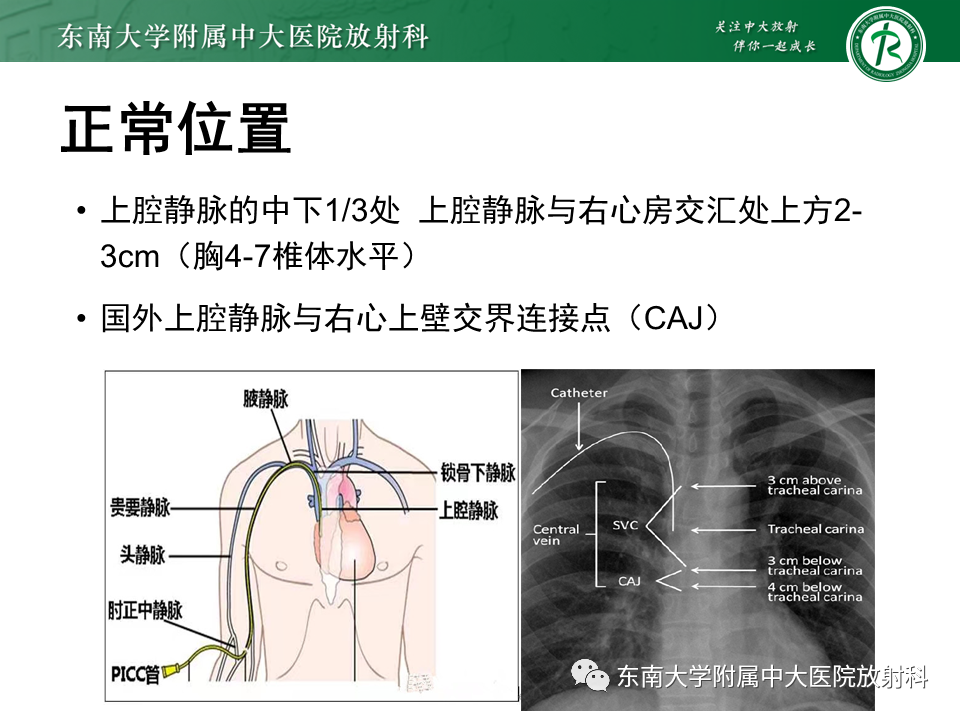 影像PPT - 【PPT】体内常见置管位置影像评估-15