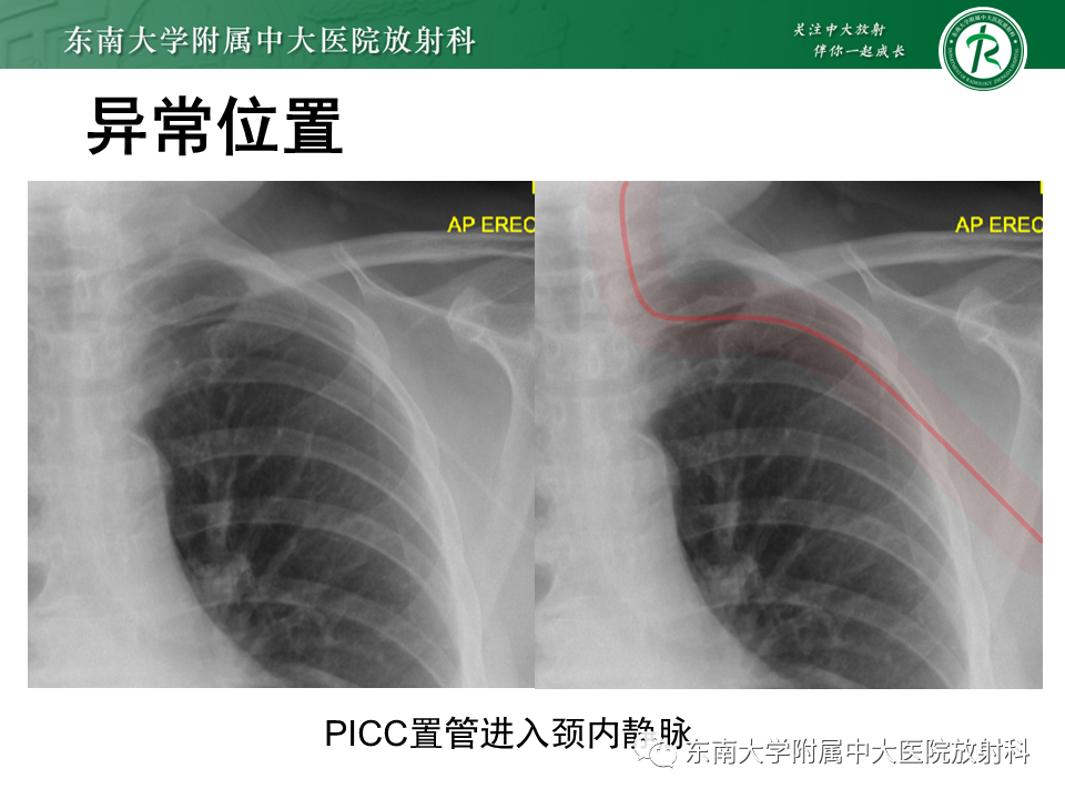 影像PPT - 【PPT】体内常见置管位置影像评估-16