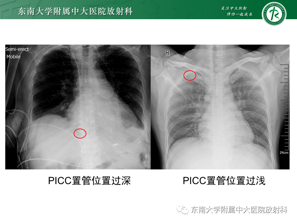 影像PPT - 【PPT】体内常见置管位置影像评估-17