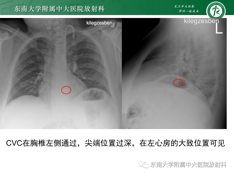影像PPT - 【PPT】体内常见置管位置影像评估-20