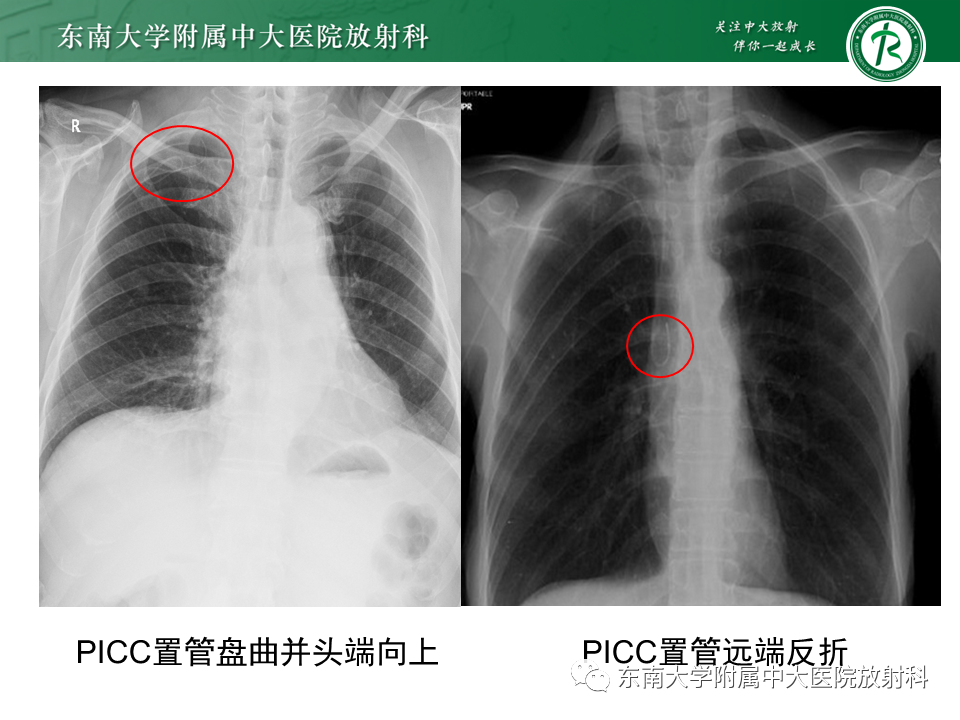 影像PPT - 【PPT】体内常见置管位置影像评估-19