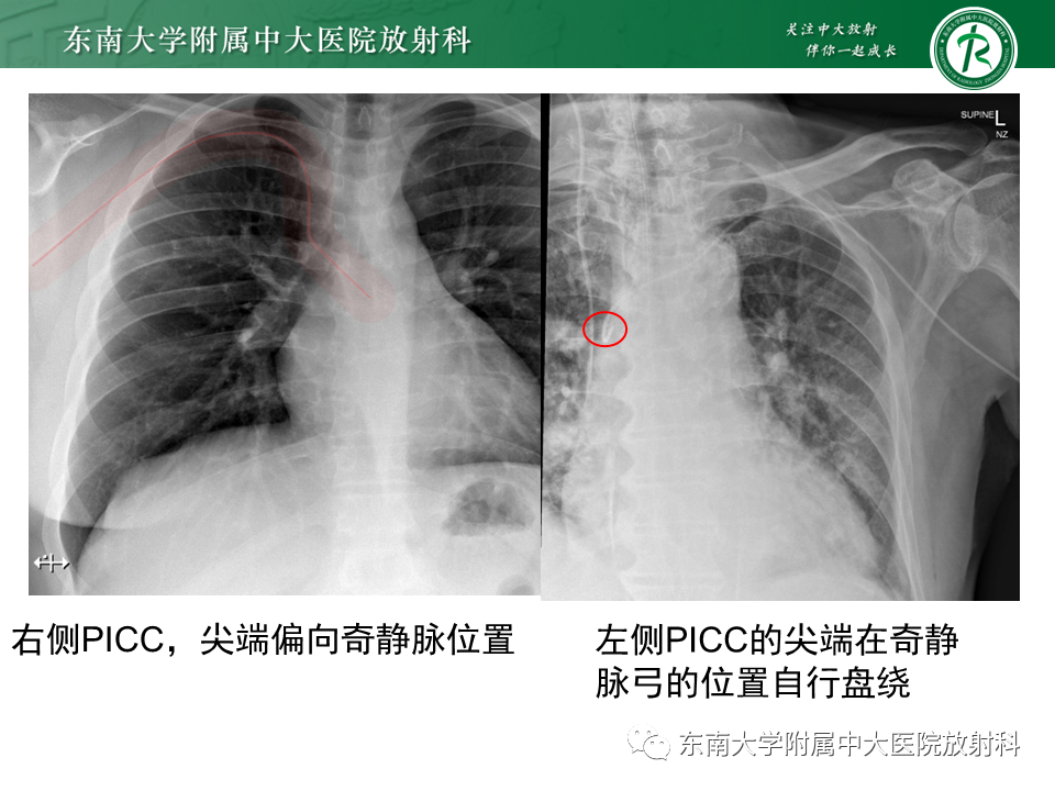 影像PPT - 【PPT】体内常见置管位置影像评估-18