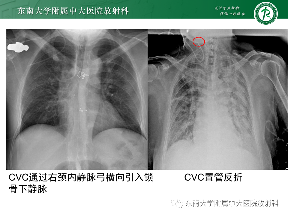 影像PPT - 【PPT】体内常见置管位置影像评估-21