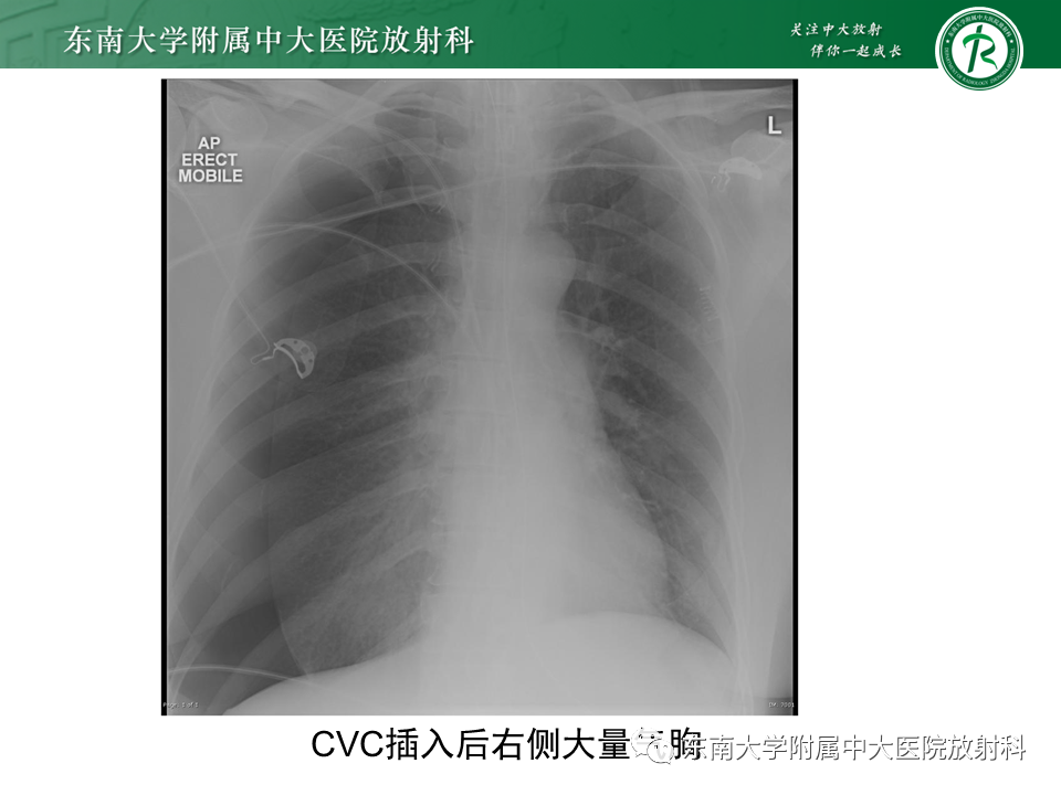 影像PPT - 【PPT】体内常见置管位置影像评估-22