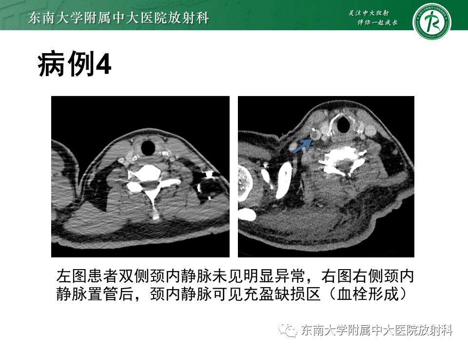 影像PPT - 【PPT】体内常见置管位置影像评估-23