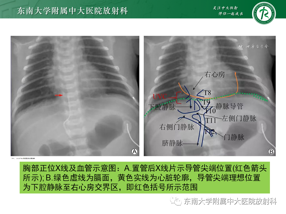影像PPT - 【PPT】体内常见置管位置影像评估-27