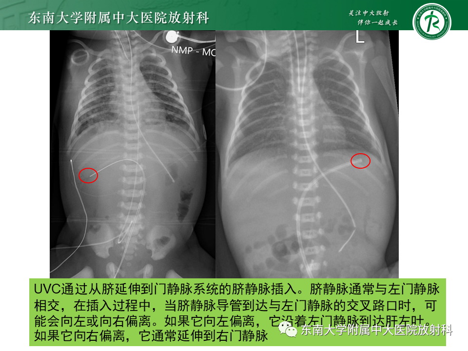 影像PPT - 【PPT】体内常见置管位置影像评估-28