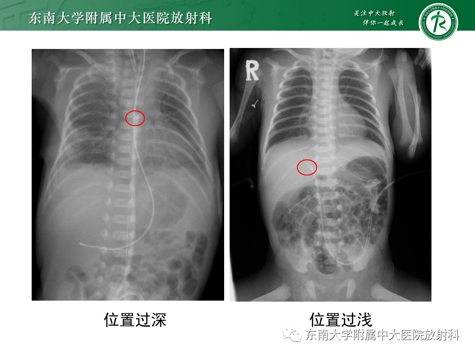 影像PPT - 【PPT】体内常见置管位置影像评估-30