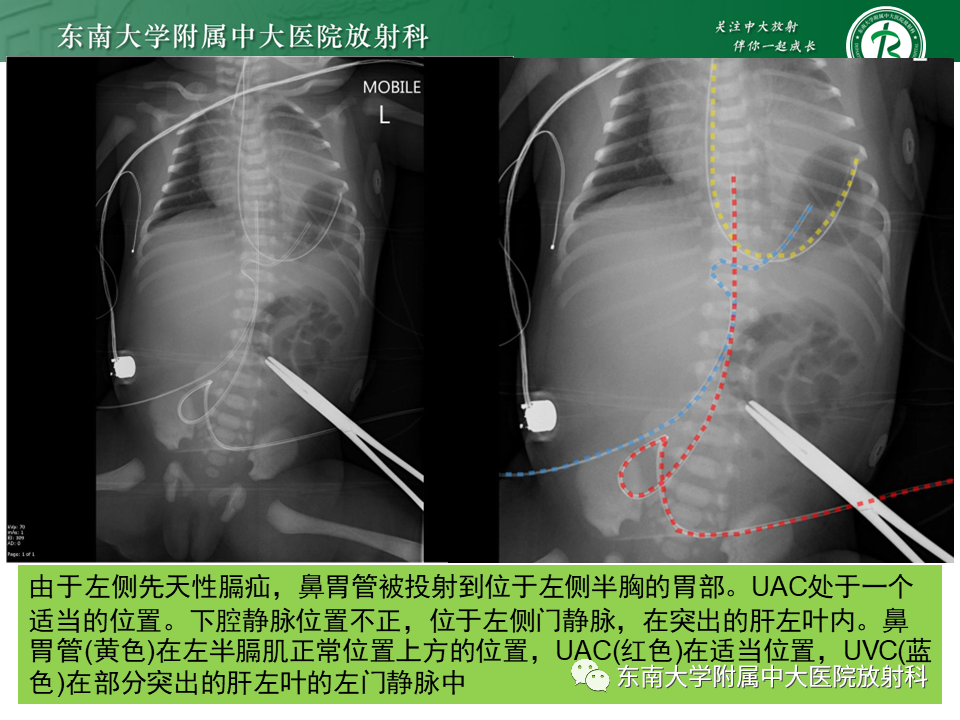 影像PPT - 【PPT】体内常见置管位置影像评估-29